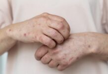 Dokter Muda di Cianjur Meninggal Diduga Campak, Dinkes Tunggu Hasil Lab untuk Pastikan Penyebab dokter meninggal di cianjur diduga karena campak